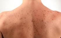 Brown spots on the skin - all the causes and their treatment Dark rough spots on the skin