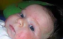 Атопічний дерматит у дітей – лікування, причини, симптоми, препарати