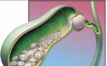 Чому з'являються камені в нирках і як їх лікувати Про що говорять камені в нирках