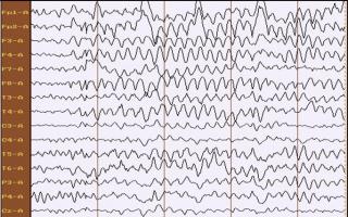 뇌의 뇌파(EEG) 매개변수 해독