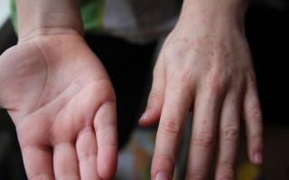 Virus Coxsackie: vale la pena avere paura Che aspetto ha la varicella turca