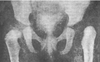 Kalça deformiteleri Varus deformitesinin tanısı