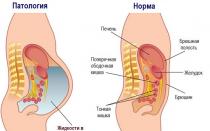 Symtom och behandling av abdominal ascites Varför vätska samlas i buken