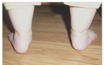 Schorzenia ortopedyczne u dzieci Dziecko kładzie jedną nogę do wewnątrz