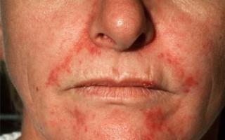 Red spots on the beard in women Irritation under the nose and on the chin