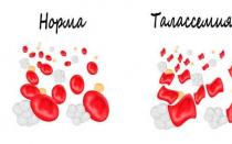 Como é tratada a talassemia e quais são os sintomas da doença em adultos e crianças Então, o que é comum entre talassemia menor e anemia ferropriva