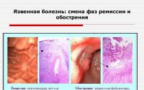 Stomach ulcer remission Use of folk remedies